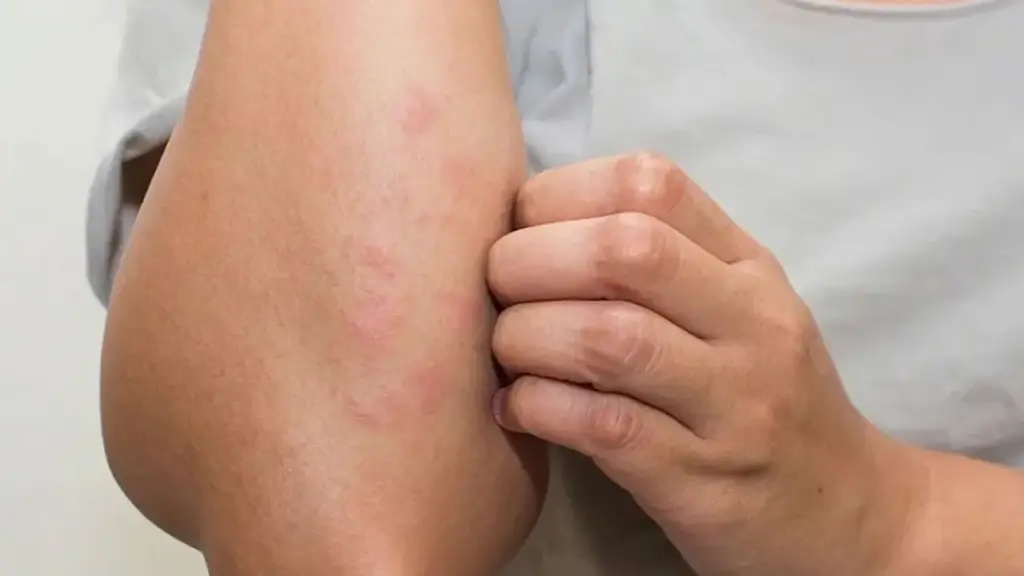 7 triệu chứng âm thầm cảnh báo suy thận