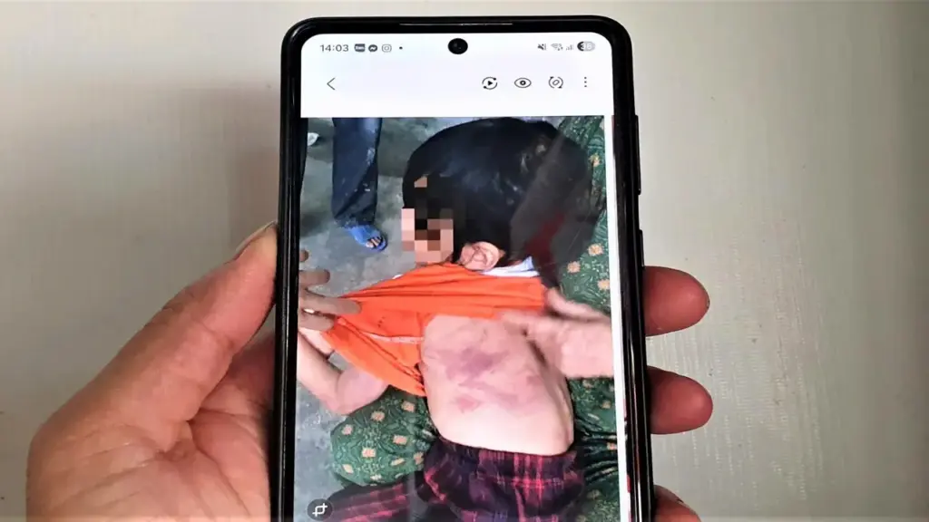 Bé gái lớp 2 bị bạn đánh bầm tím da vì lời hứa "cho kẹo"