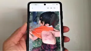 Bé gái lớp 2 bị bạn đánh bầm tím da vì lời hứa "cho kẹo"