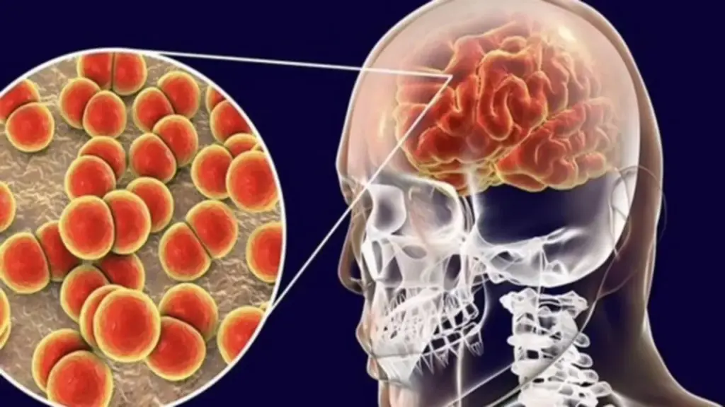 Cà Mau ghi nhận 3 ca nghi viêm não mô cầu, 1 trường hợp tử vong