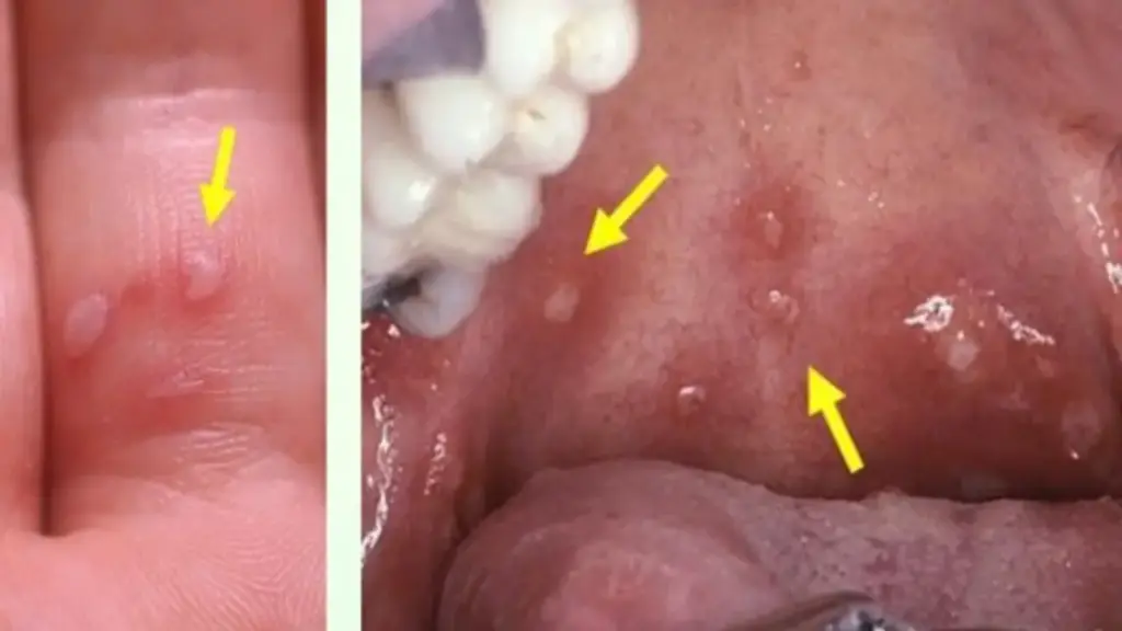 TP.HCM: Biến thể mới gây tay chân miệng nguy hiểm thế nào và dấu hiệu chuyển nặng?